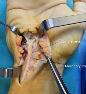El bileğinde Guyon kanalı serbestleştirildikten sonra ulnar sinir, gevşek mezonöryum ve epinöral arter
