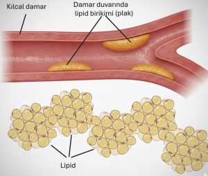 Kılcal damar duvarında damarı daraltan lipid birikimini (plak) ve lipid kümelerini gösteren çizim