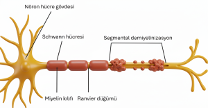 Segmental demiyelinizasyon çizimi: nöron, Schwann hücresi, Ranvier düğümü ve bölüm bölüm bozulan miyelin kılıfı